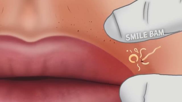 Взрыв комков кожного сала!