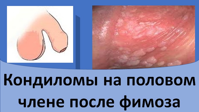 Кондиломы головки полового члена после фимоза