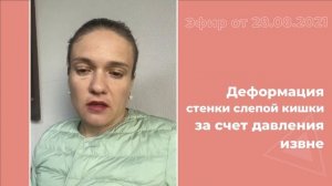 Деформация стенки слепой кишки за счет давления извне