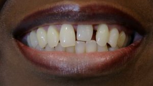 New CHALLENGE SMILE MAKEOVER- BRIGHTER IMAGE LAB -Must See Before and Afters!!