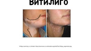 Витилиго. Болезнь белых пятен. #сыпь#витилиго#сыпь#подготовкакusmle