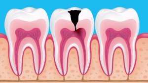 Как развивается кариес