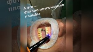 Лечение кариеса, установка световой фотополимерной пломбы