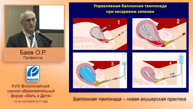 Управляемая баллонная тампонада Новая акушерская тактика Послеродовые кровотечения смотреть онлайн