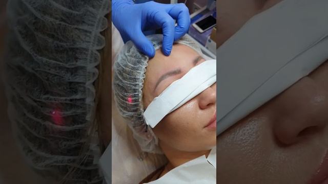 Удаление татуажа и карбоновый пилинг