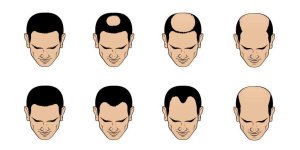 О показаниях к пересадке волос, и когда не стоит делать операцию.