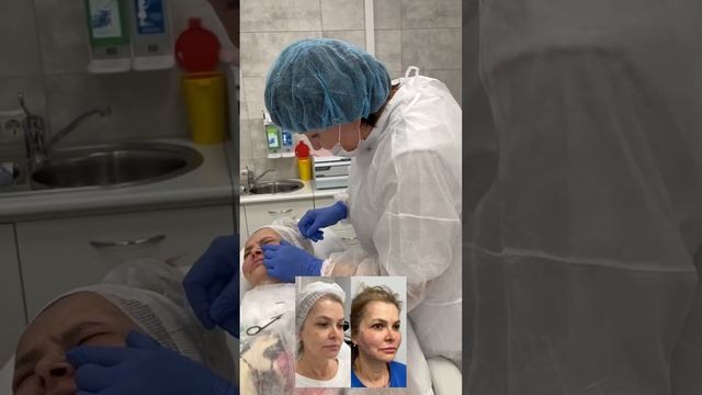 Нитевой лифтинг Aptos смотреть онлайн