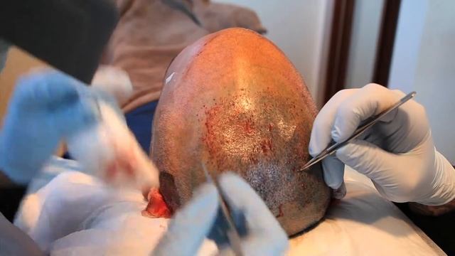 ADLER MD HAIR RESTORATION смотреть онлайн