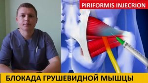 Лекарственная блокада грушевидной мышцы техника Piriformis Block Injections 