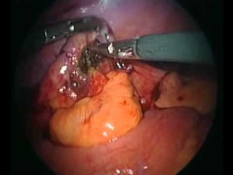 аппендицит лапароскопическое удаление смотреть онлайн