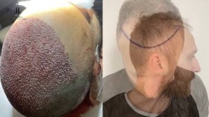 hair transplant in Bellus clinic