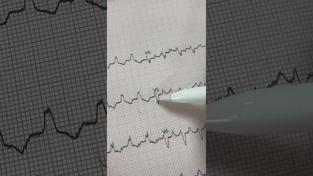 RBBB ( M pattern in V 1, V 2 and W pattern in V 5, V 6) and AF (Absent P wave) | #bkdrmuskaan