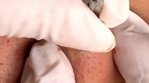 Satisfying pimple popping #2