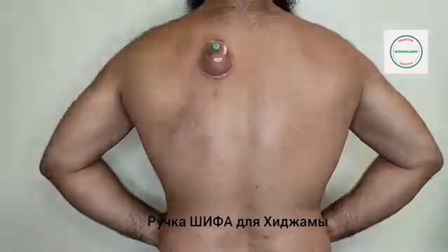 Рекомендуемые точки Хиджамы при избыточном весе!