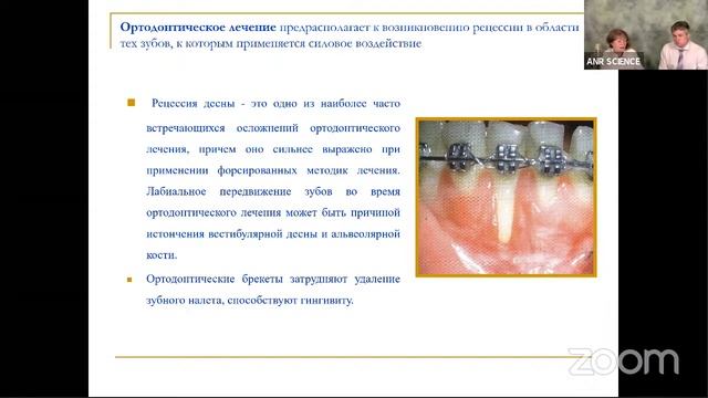 Пародонтит и рецессия десны