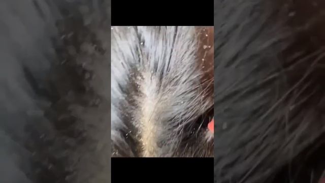 i was really worried  about my hairfall, then i saw this video  on INSTAGRAM #shorts #tig #dandruff