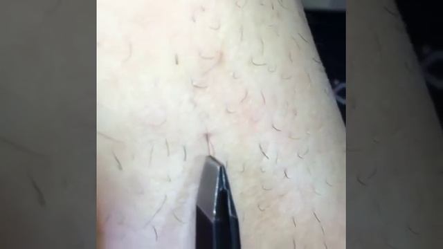 Вросший волос смотреть онлайн