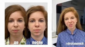 УВЕЛИЧЕНИЕ ПОДБОРОДКА / DR SITANOVICH