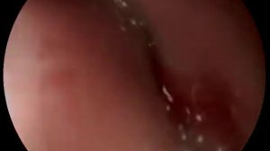 Полип антрального отдела желудка 0-IIb+IIc