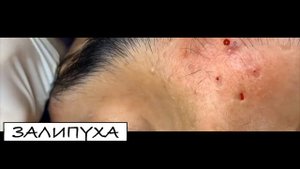 ВЫДАВЛИВАНИЕ ПРЫЩЕЙ. ПРЫЩИ ВЫДАВЛИВАНИЕ. ЧЕРНЫЕ ПРЫЩИ НА ЛИЦЕ. #acne #прыщи #ПРЫЩИВЫДАВЛИВАНИЕ