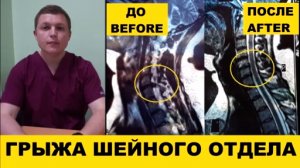 Грыжа Диска ВЫЛЕЧИЛ БЕЗ ОПЕРАЦИИ Herniated Disc Treatment