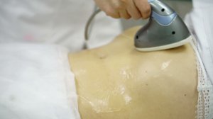 RF-лифтинг тела.