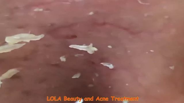 Exploding Whiteheads on the Nose with Tweezer