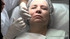 Коррекция носогубной складки
