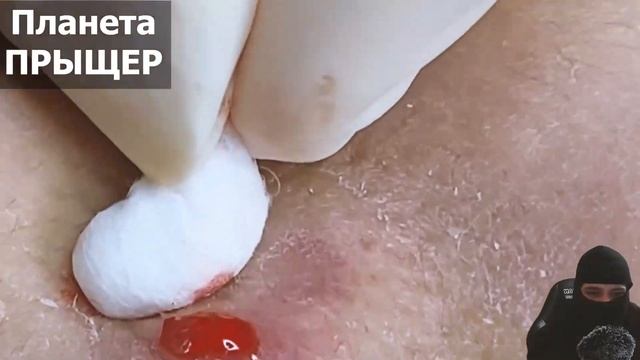 ПРЫЩЕР - Довольно сложный случай! Чистка лица, прыщи, черные точки.? "Прыщевой путь" (4 серия). смотреть онлайн