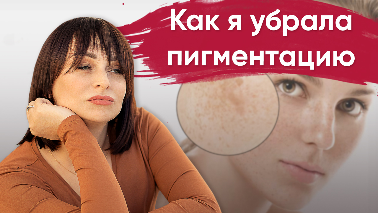 Пигментация: причины, как избавиться от пигментных пятен.