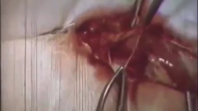 Классификация и механизмы образования грыж, их хирургическое лечение