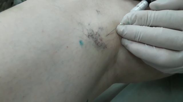 Удаление сосудистой звездочки и варикозной вены методом склеротерапии