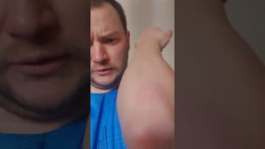 лечение псориаза препаратом эфлейра в онлайн режиме, 3 недели после 3го укола , 2.05.2022