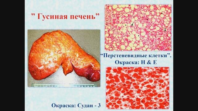 Патология - Лекция: Введение в патологию. Паренхиматозные дистрофии.