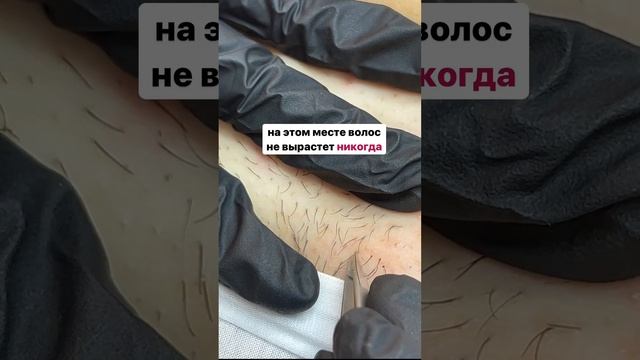 Электроэпиляция удаляет каждый волосок навсегда, а лазер временно? #электроэпиляциямосква