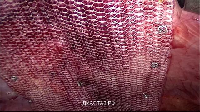 грыжевая сетка при диастазе смотреть онлайн