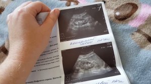 Как вылечить кисты почек и камни в почках. УЗИ почек