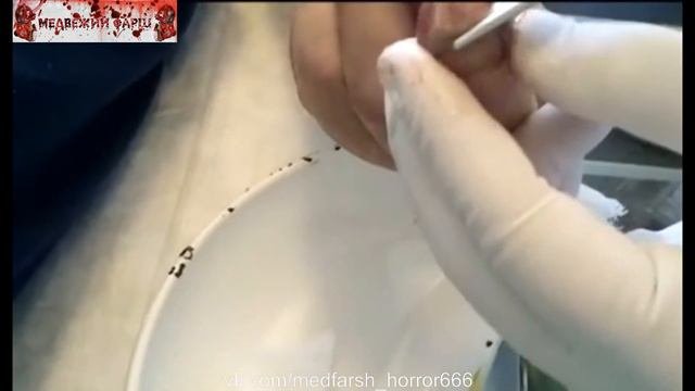 Пальчик загноился