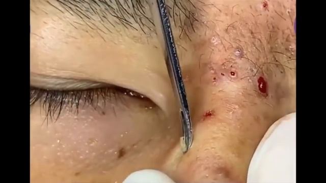 КОВЫРЯЕМ ЧЕРНЫЕ ТОЧКИ, ПРЫЩИ НА НОСУ УСПОКАЕВАЮЩИЕ ВИДЕО С МУЗЫКОЙ ДЛЯ СНА