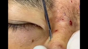 КОВЫРЯЕМ ЧЕРНЫЕ ТОЧКИ, ПРЫЩИ НА НОСУ УСПОКАЕВАЮЩИЕ ВИДЕО С МУЗЫКОЙ ДЛЯ СНА