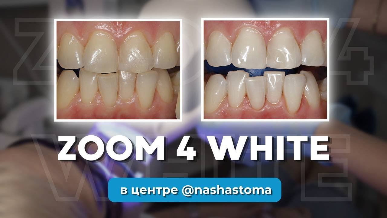 Как проходит отбеливание zoom 4 white в клинике "Наша Стоматология" СПб