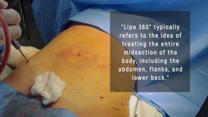Awake Liposuction 360° With Hip Dip Correction. Dr. Alexey Markelov of AM Plastic Surgery.
