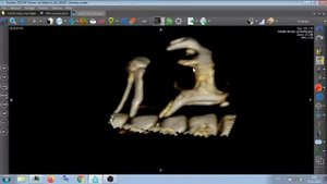 КОСТИ ГОРТАНИ НА КТ .