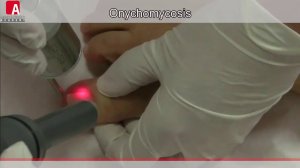 Лечение грибка ногтей лазером Fotona