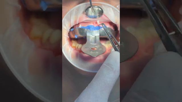 Какие были зубы ДО, в предыдущем видео 😄 #dental #стоматология #имплантациязубов #emax #виниры