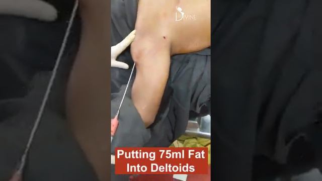 Deltoid Creation Surgery | Biceps Creation Surgery | On Table Before After Deltoid Creation