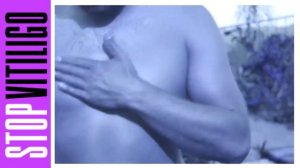 Новая светодиодная лампа от витилиго и псориаза. Длинна волны 311 нм.