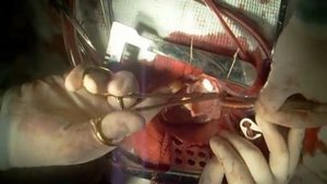 Пластика дефекта межпредсердной перегородки