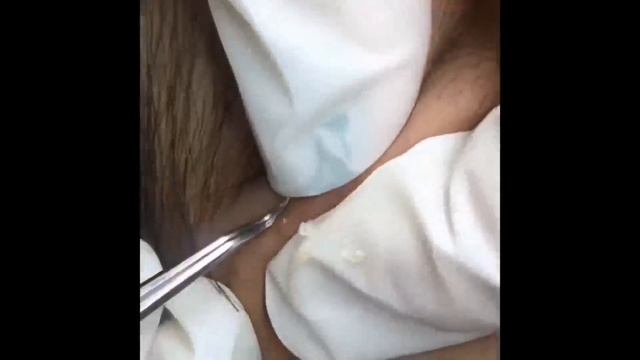 НОВОЕ ВИДЕО 2021  Прыщи давить залипательные