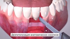 Geistlich Fibro Gide Закрытие одиночной рецессии десны